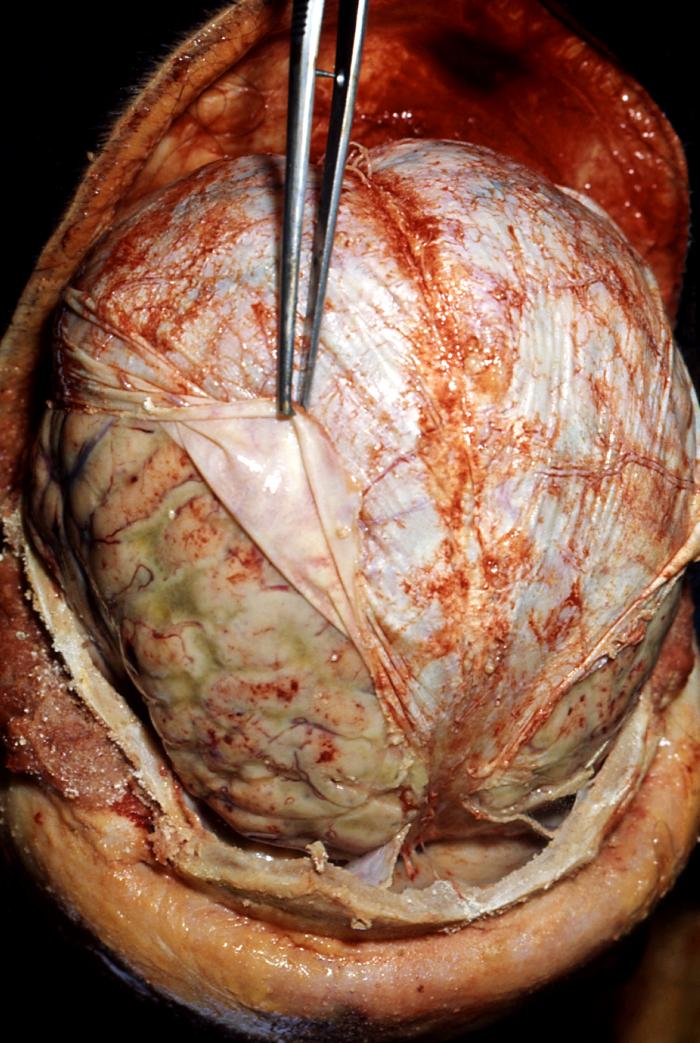 Pneumococcal meningitis in an alcoholic paitent