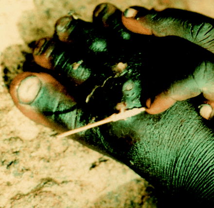 Guinea Worm Disease