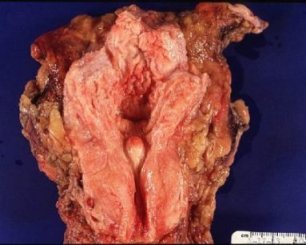 Prostate and Bladder of an autopopsy of a man who had Benign Prostatic Hyperplasia