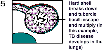 tubercle tuberculosis