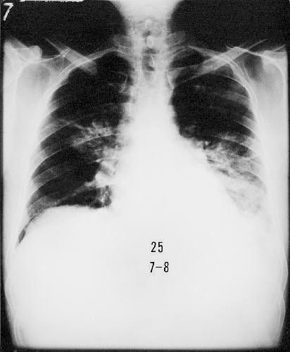 Chest radiograph of patient with Legionnaire's Disease found at wrongdiagnosis.com