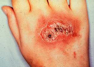 A. fumigatus infection of the hand, Courtesy of Dr. Volk