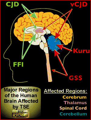 Diagram shows brain areas affected by prion diseases. Courtesy of http://whyfiles.org/193prion/3.html.