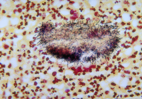Actinomycetoma, picture taken from free domain