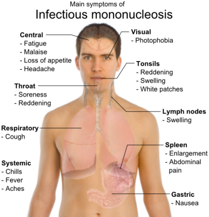 These are the common symptoms of Infectious Mononucleosis.  These symptoms can vary in severity and can be expressed at different times, if expressed at all.  Click on the picture to view it in its original source.
