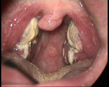 Mono In Mouth 102