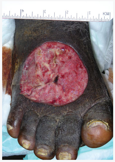 Aeromonas hydrophila wound infection. Image used with permission by Consultant/HMP Communications.