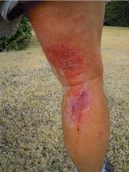 Image shows a pretty severe reaction to poison oak on the leg of this individual.