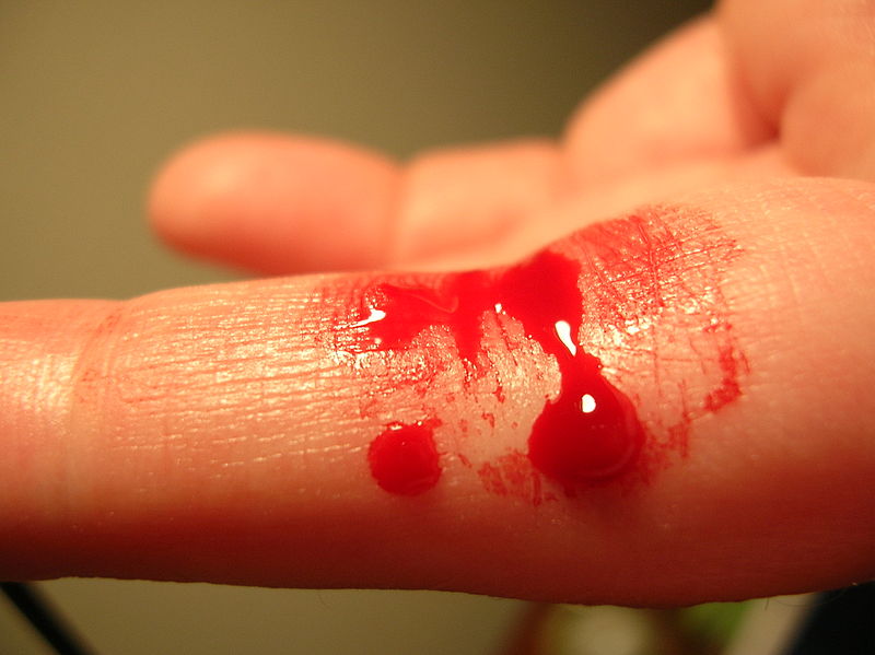 Bloody finger. Property of: Flickr