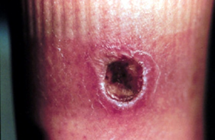 This is a minor lesion due to a brown recluse bite.  The photo is the property of www.BrownRecluseBite.com