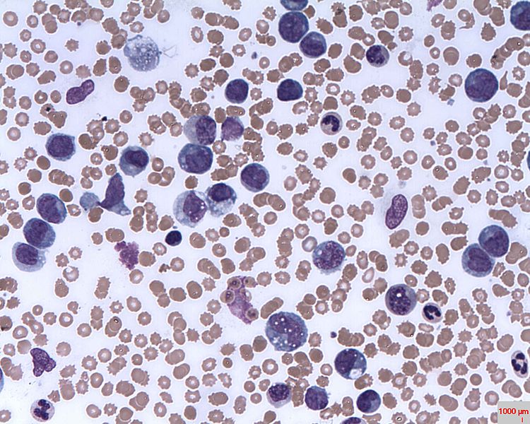 Blood infected with Leukemia