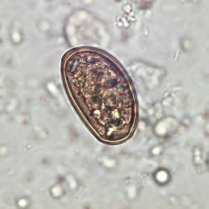 Egg of Dicrocoelium dendriticum in an unstained wet mount of stool (Courtesy of Dr. Juan Cuadros González)