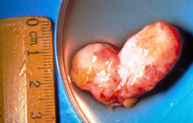 Adult Onchocerca volvulus Removed