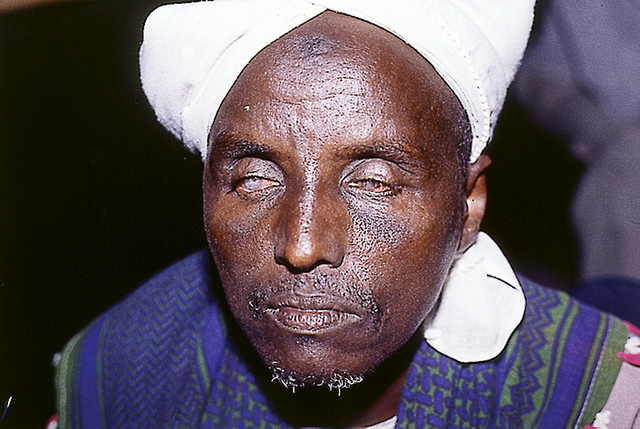 A Blind Man Infected From Onchocerciasis