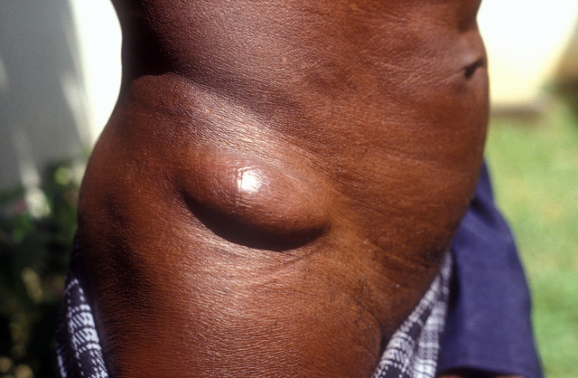 A Man Affected with Onchocerciasis