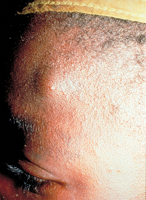 A Woman's Head Bumps from Onchocerciasis