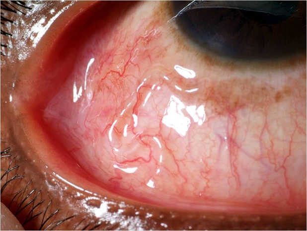 Close up of an Infected eye Copyright 2011 BMJ Publishing Group Ltd