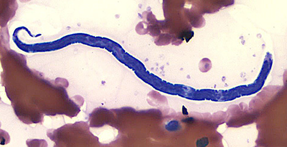 Microfilaria of Loa loa in a blood Smear, wiki commons