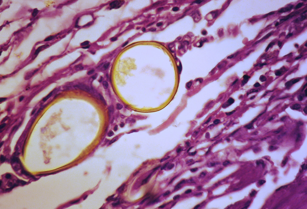 2 eggs embedded in lung tissue; Picture obtained from: https://www.flickr.com/photos/pulmonary_pathology/13381830883/in/photolist-movphK-mowtjS-mouCPD-movo78